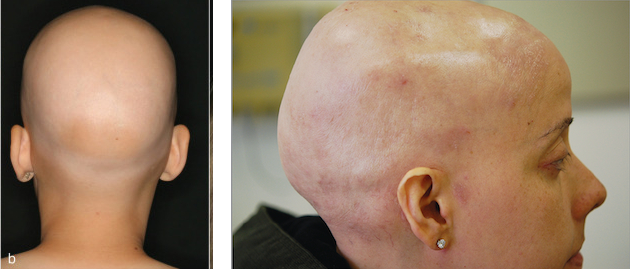 alopecia universalis