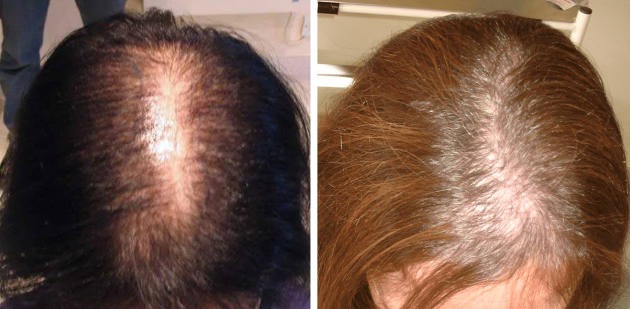 female pattern baldness