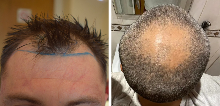 male pattern baldness