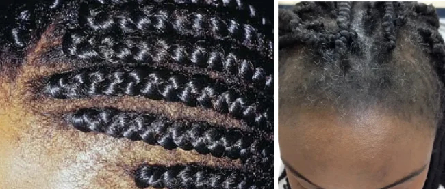 traction alopecia