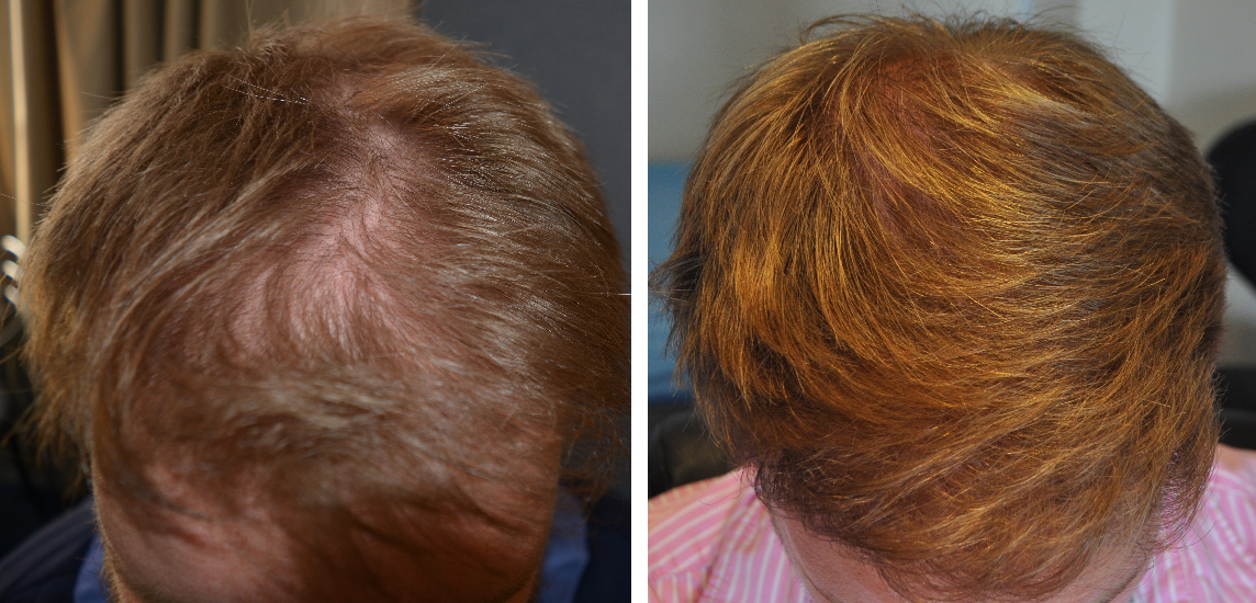 Patient before and after hair transplant