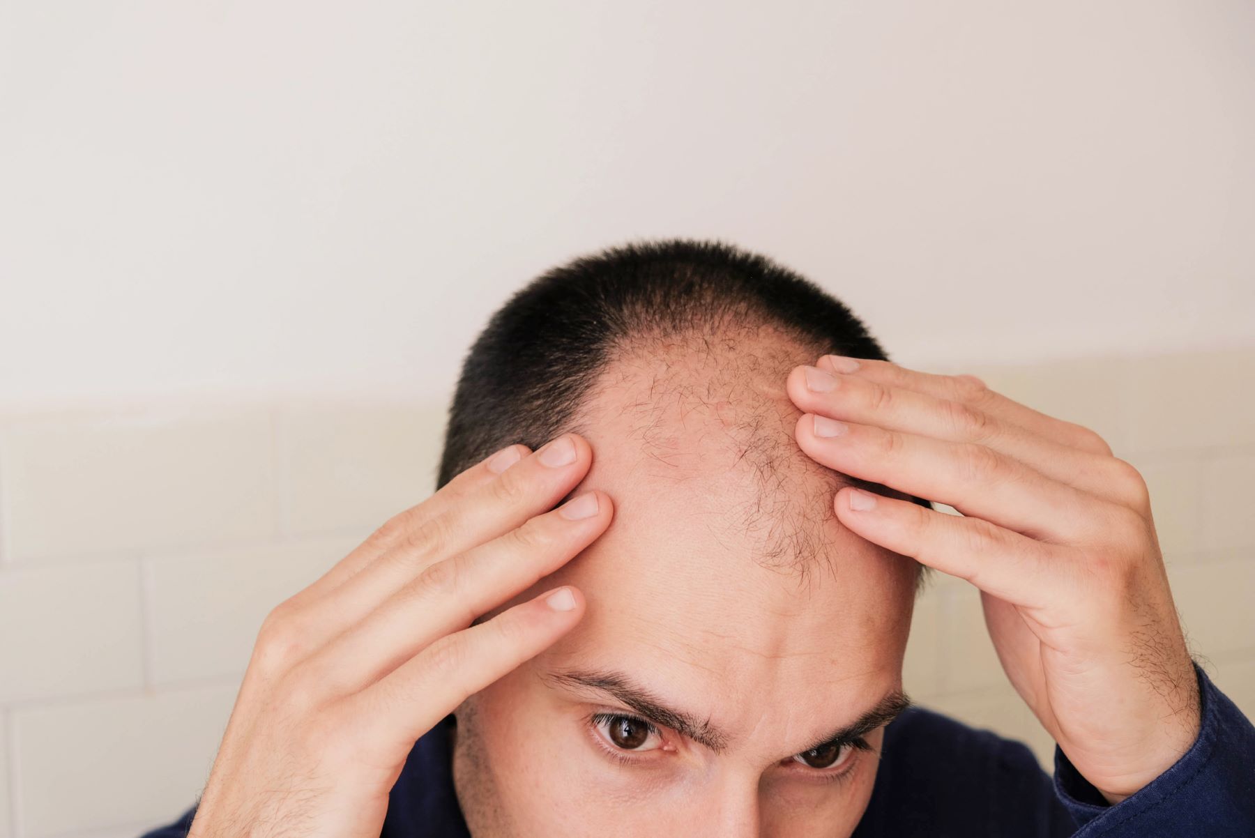 Male pattern baldness