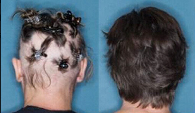 Alopecia areata before and after JAK inhibitors