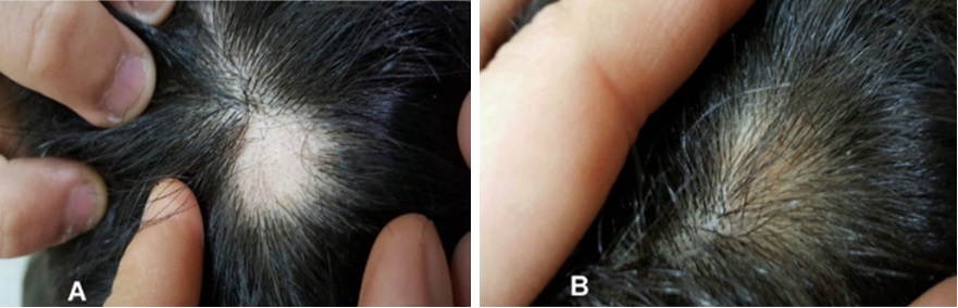 Alopecia areata before and after laser therapy