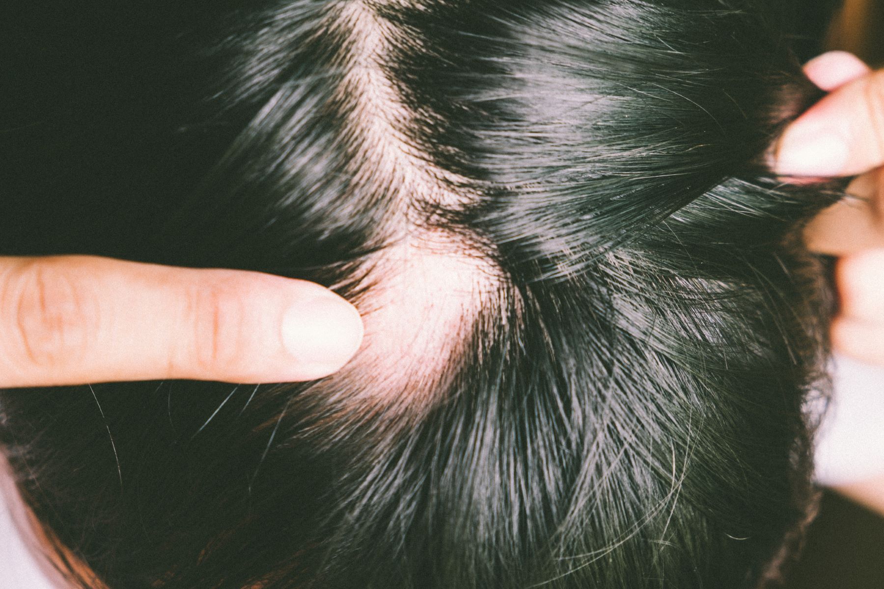 Alopecia areata does not spread by touching