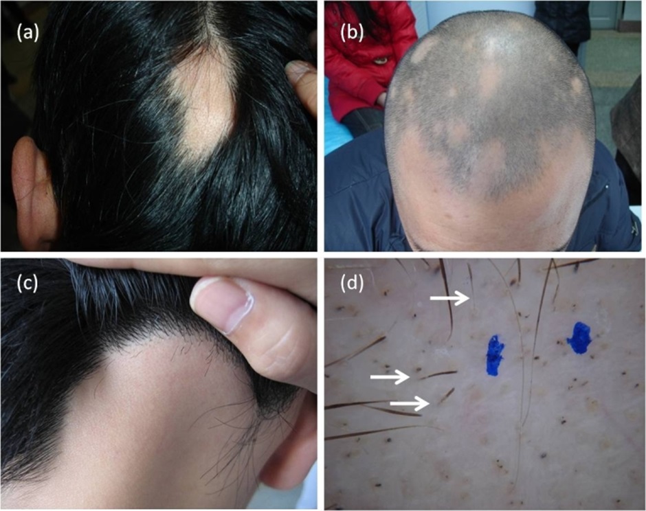 Clinical presentations of alopecia areata