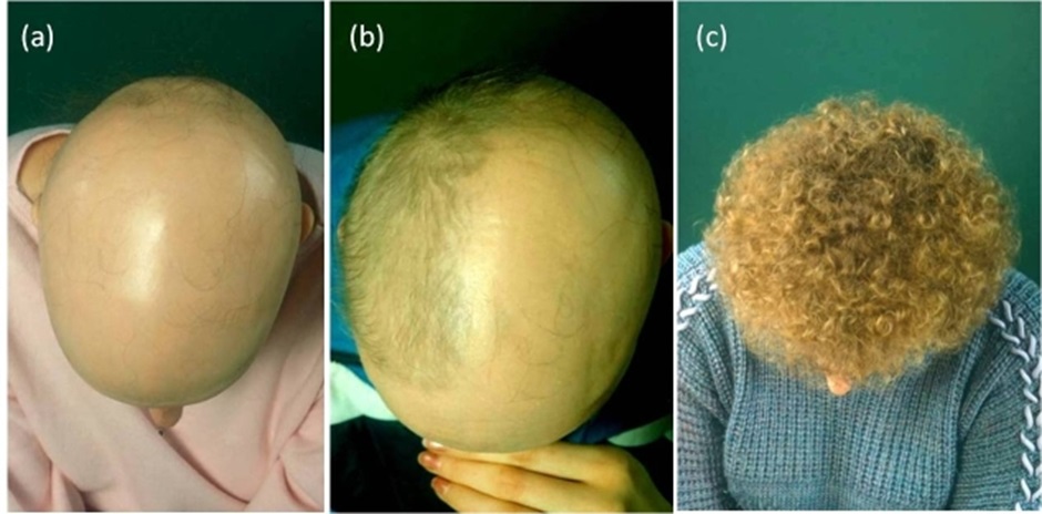 Patient with alopecia areata before and after immunotherapy