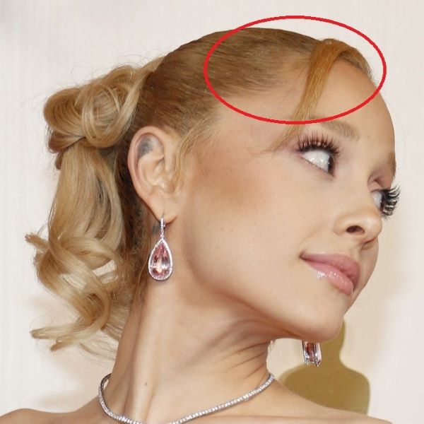 Ariana Grande traction alopecia