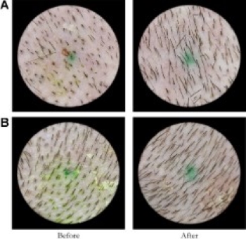 Hair count before and after red light therapy