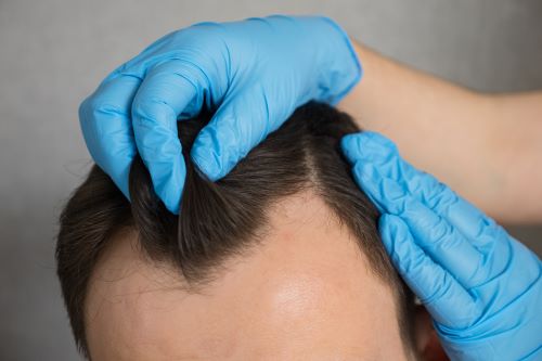 Man with androgenetic alopecia