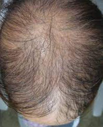 Alopecia incognita