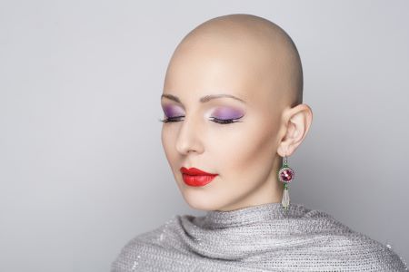 Alopecia totalis