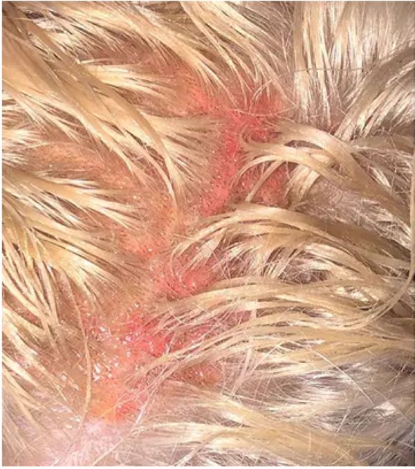 Chemical burns on the scalp