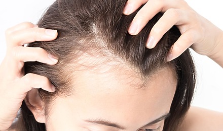 Female Temple Hair Loss: Causes, Prevention, Treatment