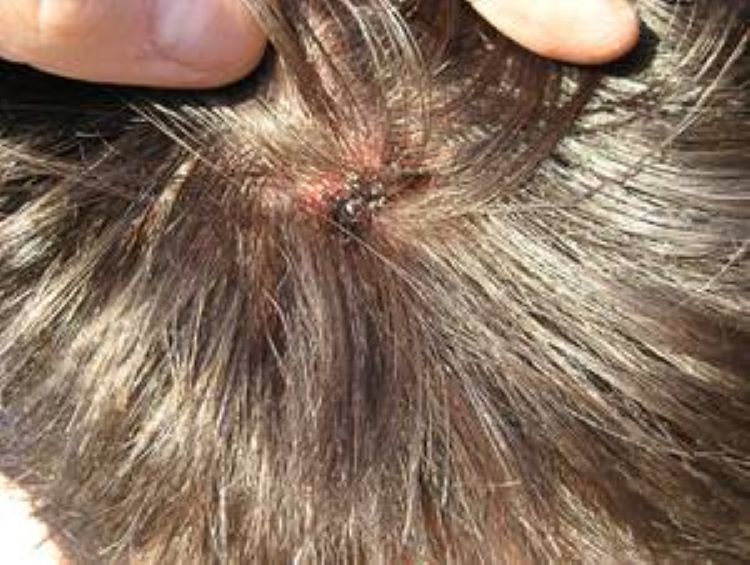 Minor scalp trauma