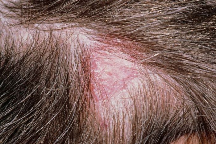 Ringworm (tinea capitis)