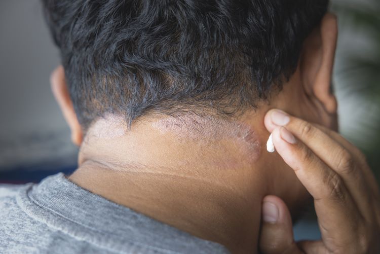 Scalp atopic dermatitis (eczema)