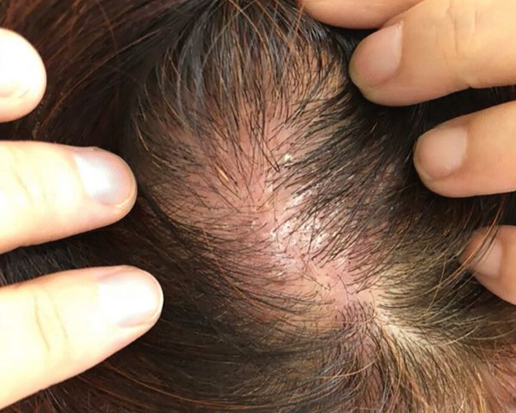 Scalp contact dermatitis