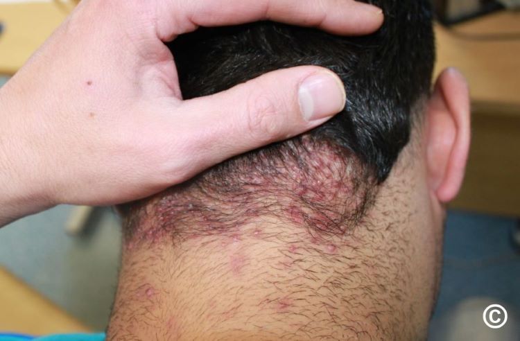 Scalp folliculitis