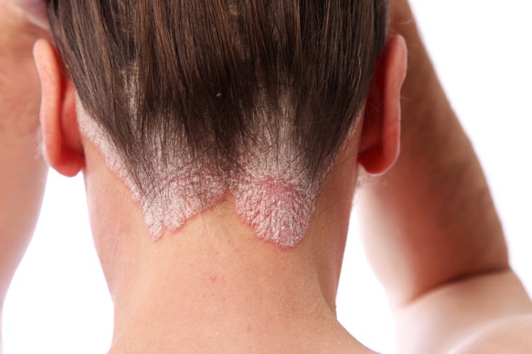 Scalp psoriasis