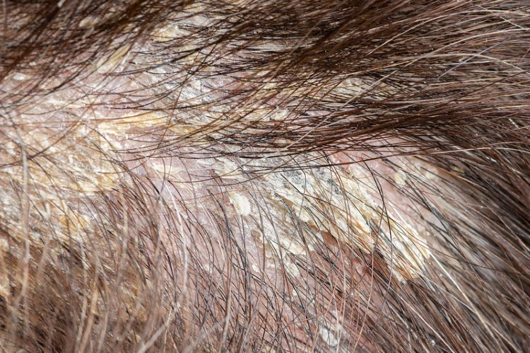 Scalp seborrheic dermatitis