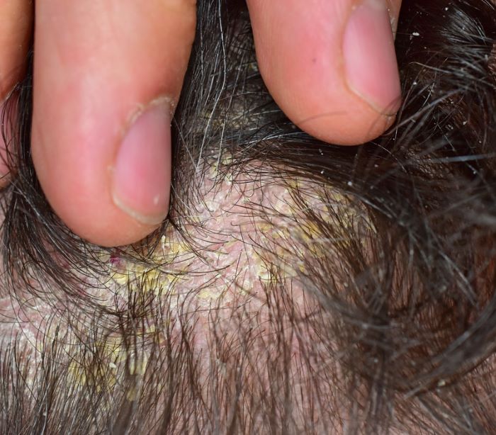 Seborrheic dermatitis