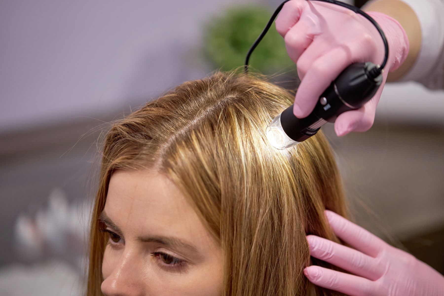 Woman getting treatment for hair loss at the temples