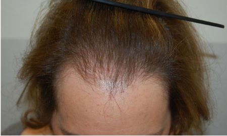 Woman with androgenetic alopecia