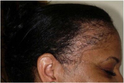 Woman with traction alopecia