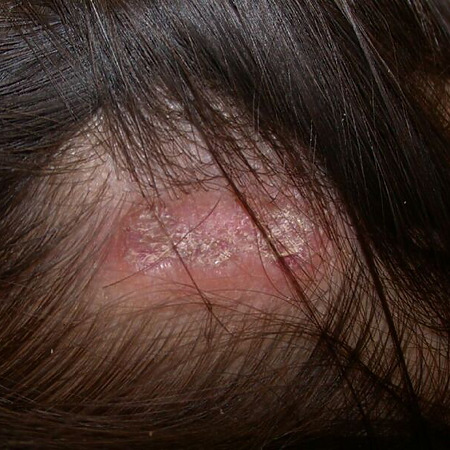 Discoid lupus