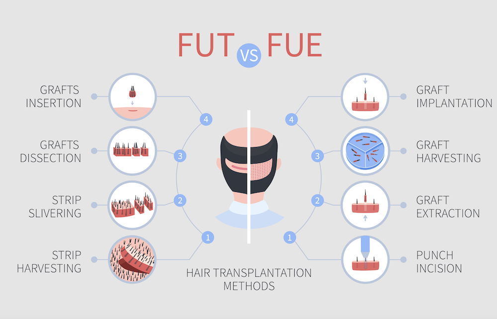 FUT vs FUE