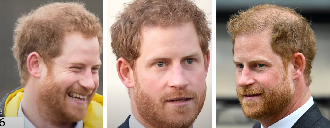 Prince Harry Hair Transplant – Everything You Need To Know