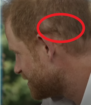 scalp scar from possible Prince Harry hair transplant