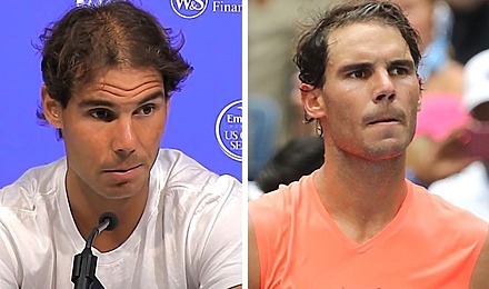 Rafael Nadal Hair Transplant: Everything You Need To Know