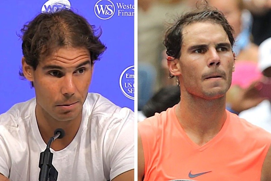 Rafael Nadal Hair Transplant: Everything You Need To Know