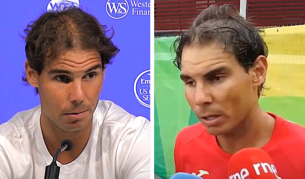 Rafael Nadal's thinning hair in 2016