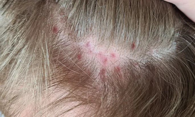 Scalp folliculitis