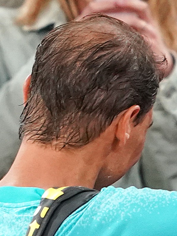 Thin hair at the back of Nadal's head