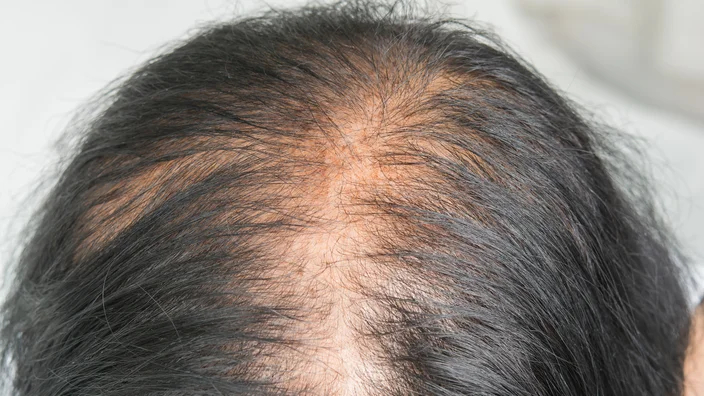 advanced female pattern hair loss