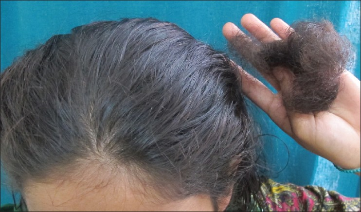 hair shedding from telogen effluvium