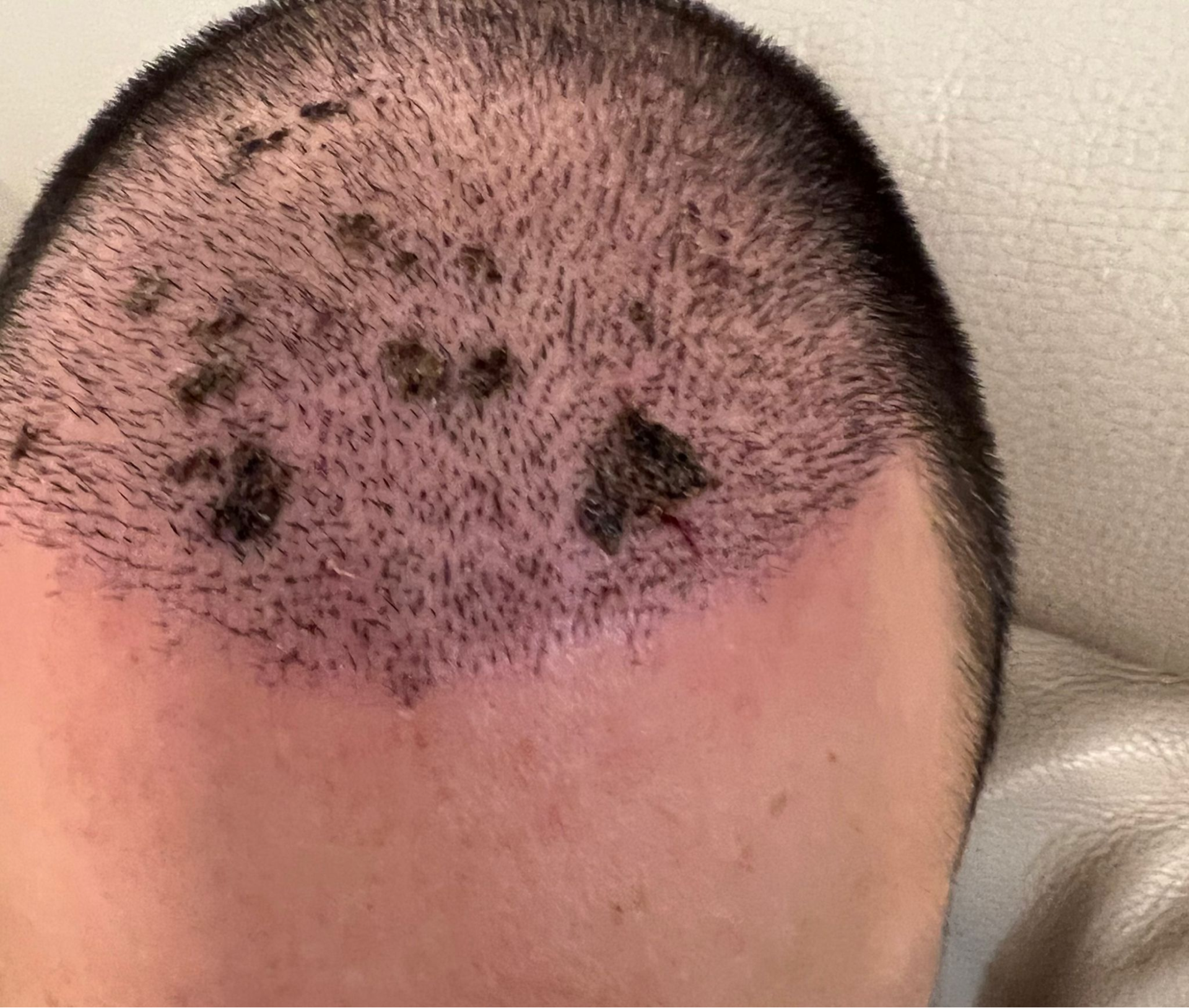 hair transplant necrosis