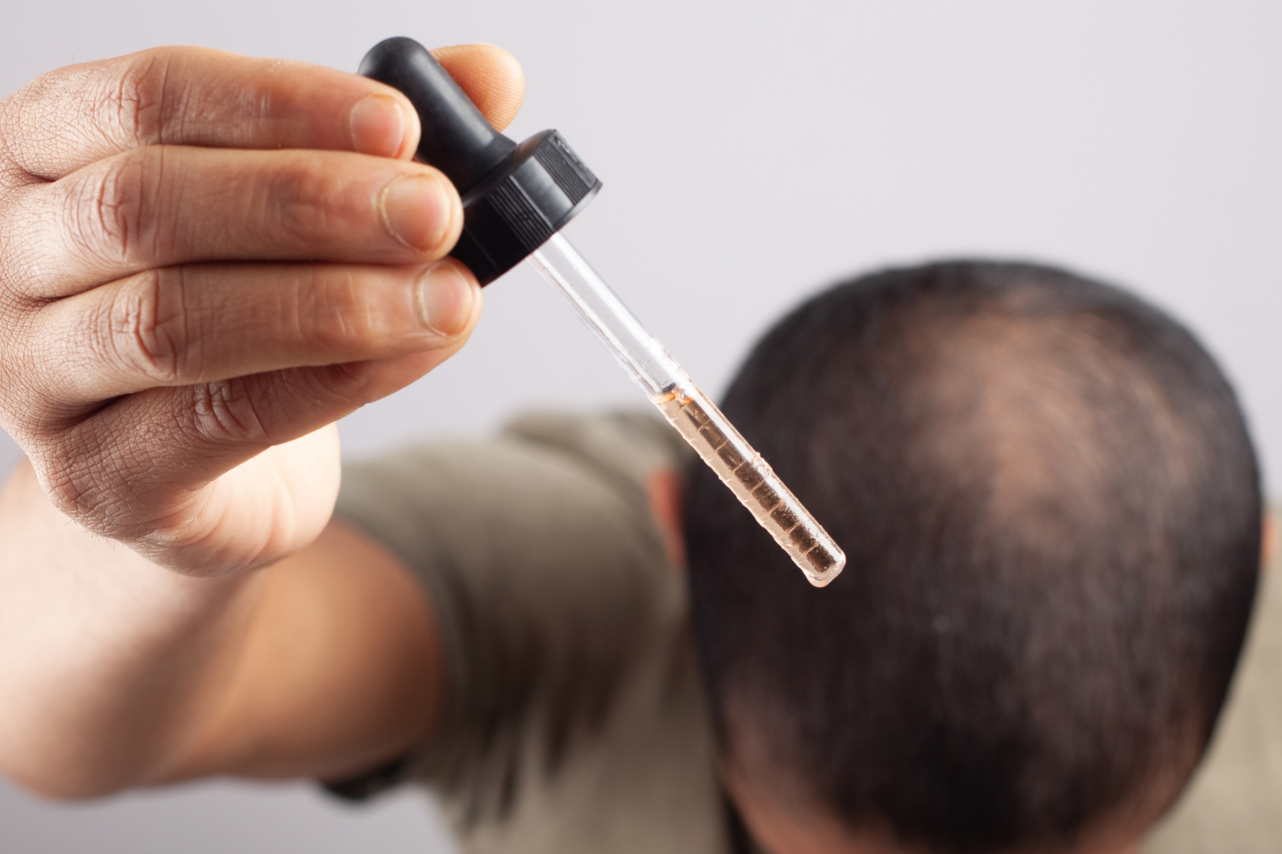 man using topical hair loss treatment