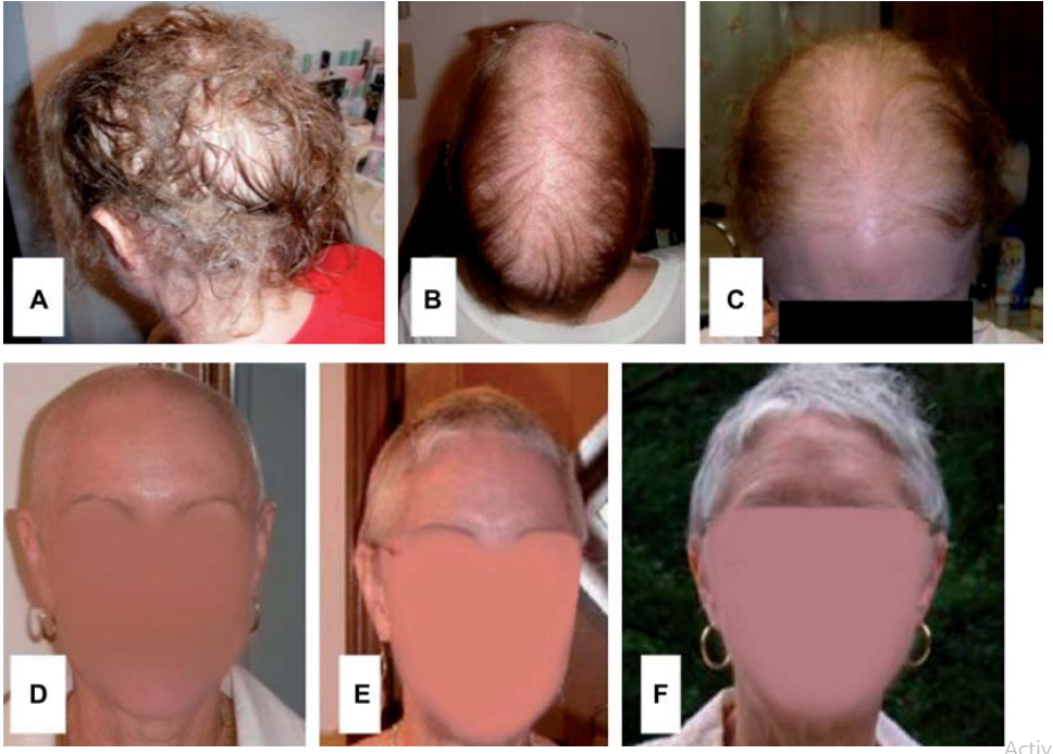 progression of hair loss due to excessive selenium