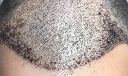 5 Reasons Your Scalp May Be Itching After A Hair Transplant