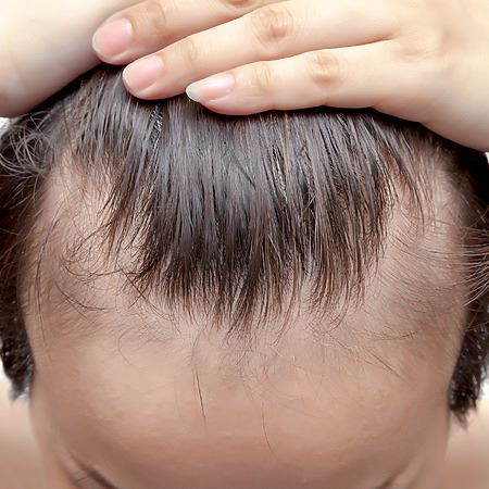 Man with androgenetic alopecia