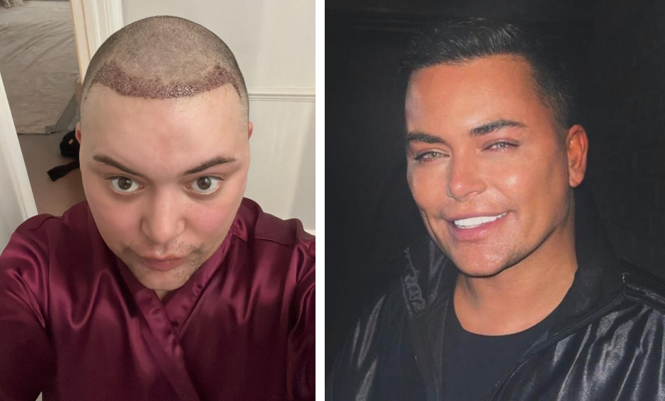 Baga Chipz before and after celebrity hair transplant