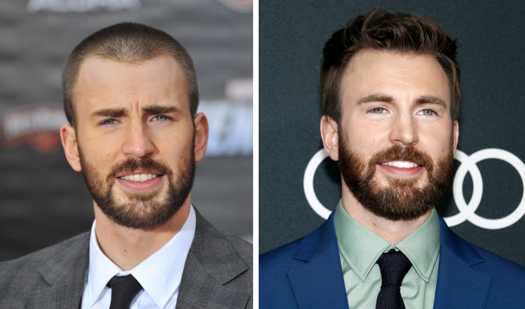 Chris Evans Hair Transplant Featured Image