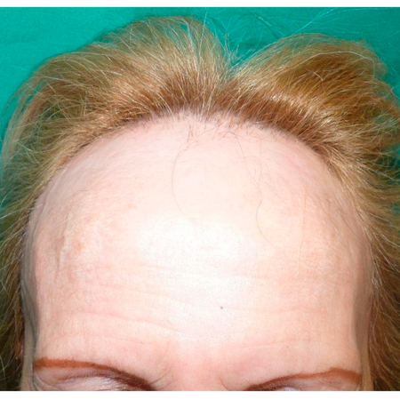 Frontal Fibrosing Alopecia