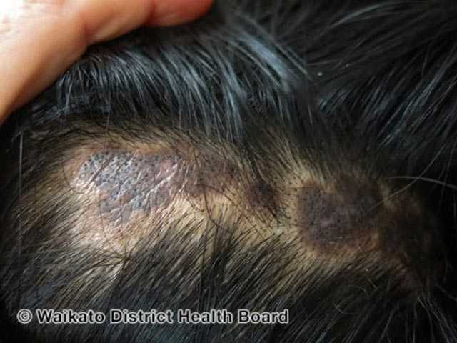 Scalp manifestation of discoid lupus