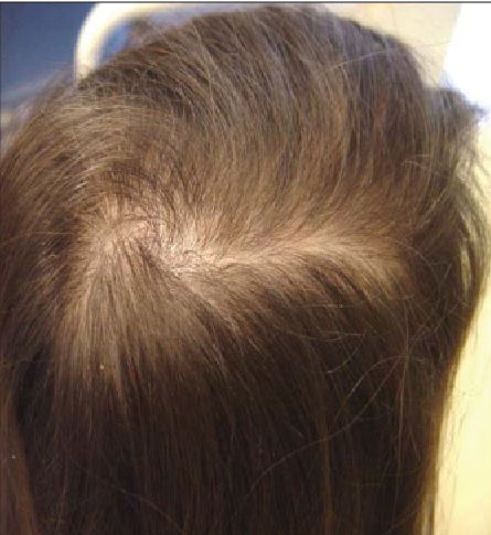 Telogen effluvium in a teenager